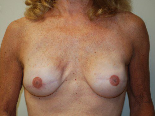 Breast Reconstruction Immediate Implant After Patient 1