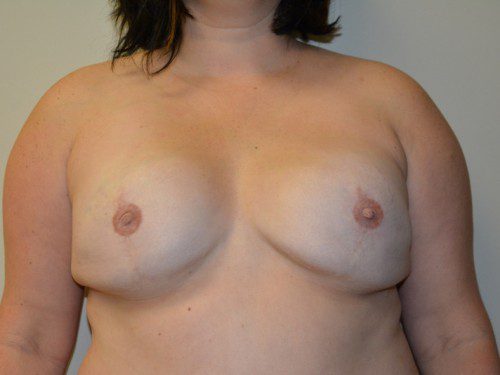 Breast Reconstruction Tissue Expanders After Patient 1