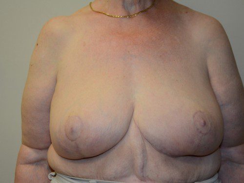 Breast Reduction After Patient 1