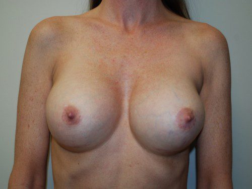 Breast Revision After Patient 1