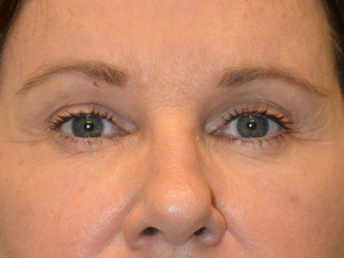 Brow Lift After Patient 1