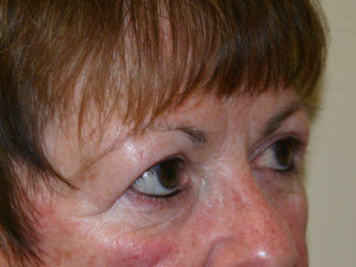 Eyelid Surgery After Patient 2