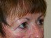Eyelid Surgery After Patient Thumbnail 2