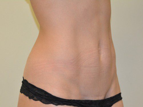 Mini Tummy Tuck After Patient 2