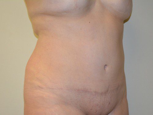 Tummy Tuck After Patient 3