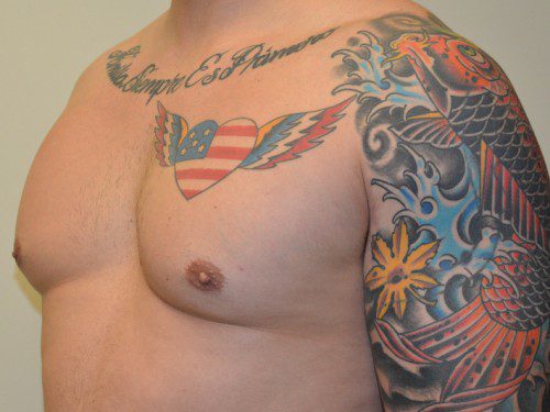 Male Breast Reduction After Patient 2