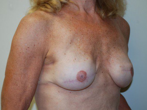 Breast Reconstruction Immediate Implant After Patient 2