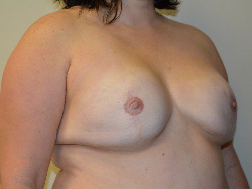 Breast Reconstruction Tissue Expanders After Patient 2