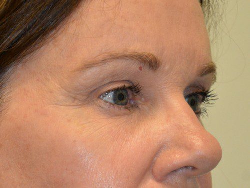 Brow Lift After Patient 3