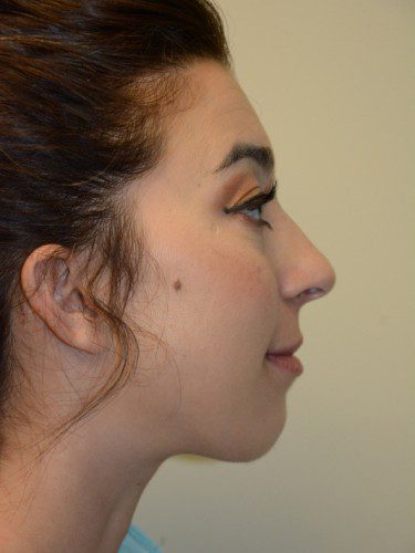 Chin Augmentation After Patient 4