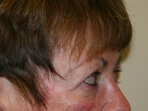 Eyelid Surgery After Patient 4