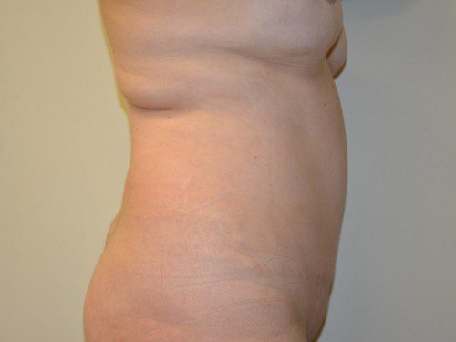 Tummy Tuck After Patient 5