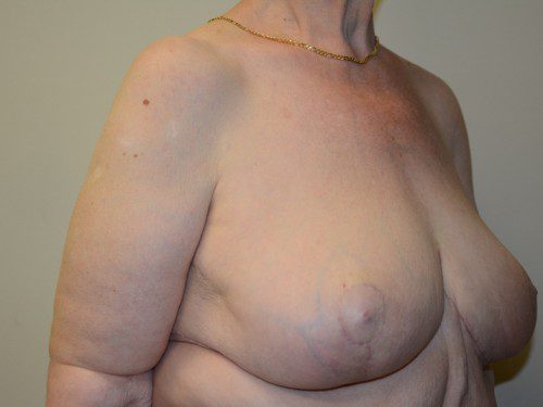 Breast Reduction After Patient 2