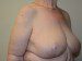 Breast Reduction After Patient Thumbnail 2
