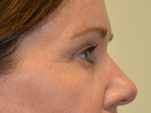 Brow Lift After Patient 5