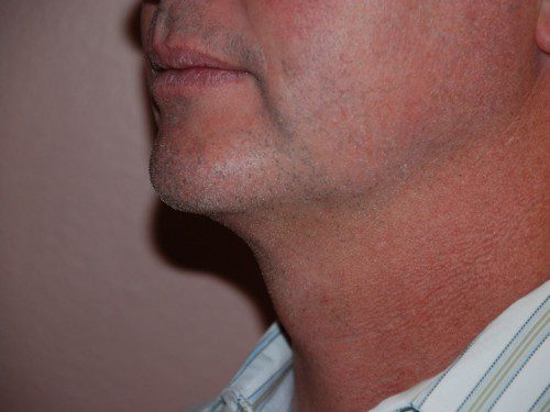 Neck Liposuction After Patient 3