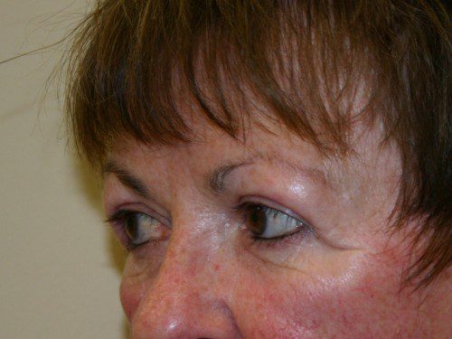 Eyelid Surgery After Patient 3