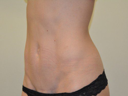 Mini Tummy Tuck After Patient 3