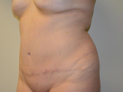 Tummy Tuck After Patient 2