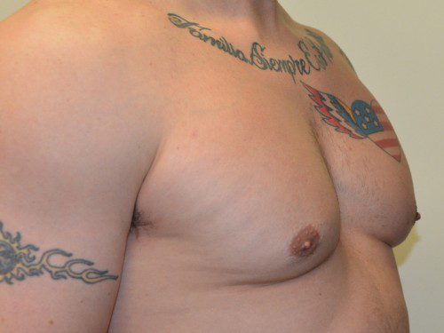 Male Breast Reduction After Patient 3