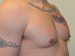 Male Breast Reduction After Patient Thumbnail 3