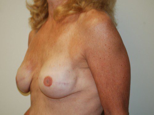 Breast Reconstruction Immediate Implant After Patient 3