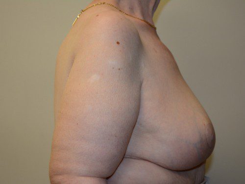 Breast Reduction After Patient 4