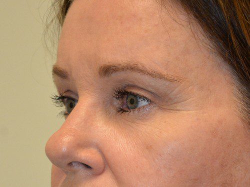 Brow Lift After Patient 2