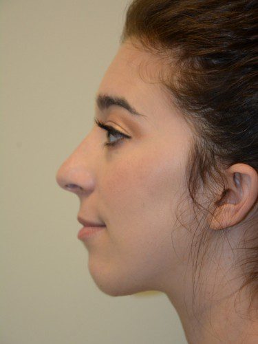 Chin Augmentation After Patient 5