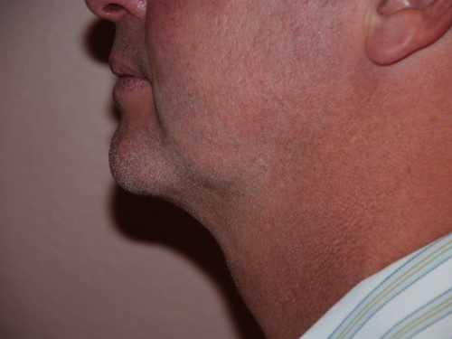 Neck Liposuction After Patient 5