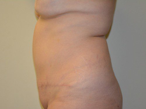 Tummy Tuck After Patient 4