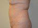 Tummy Tuck After Patient Thumbnail 4