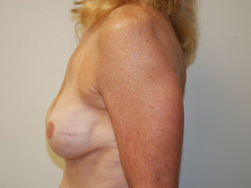 Breast Reconstruction Immediate Implant After Patient 5