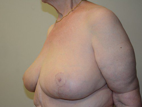 Breast Reduction After Patient 3