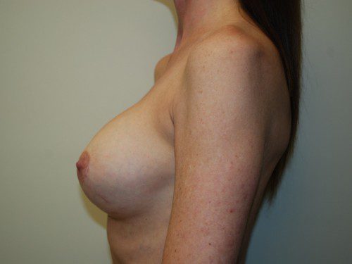 Breast Revision After Patient 5