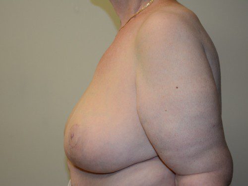 Breast Reduction After Patient 5