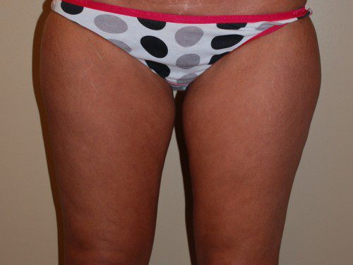 Liposuction Before Patient 1