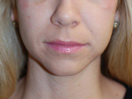 Neck Liposuction After Patient 1