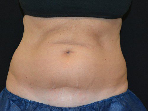 Coolsculpting Before Patient 1
