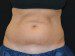 Coolsculpting Before Patient Thumbnail 1