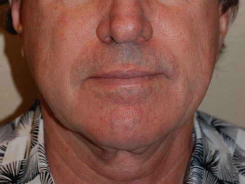 Facelift Before Patient 1