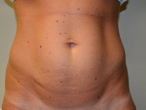 Mini Tummy Tuck Before Patient 1