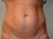 Mini Tummy Tuck Before Patient Thumbnail 1