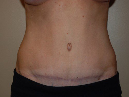 Tummy Tuck After Patient 1