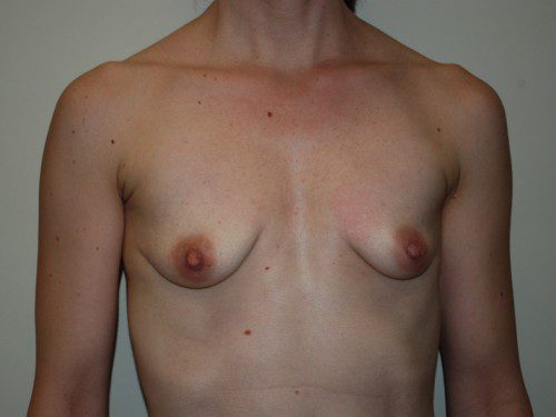 Breast Revision Before Patient 1