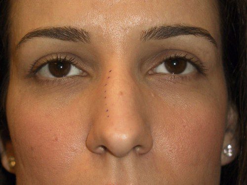 Rhinoplasty Before Patient 1