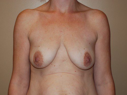 Breast Augmentation w/Lift Before Patient 1