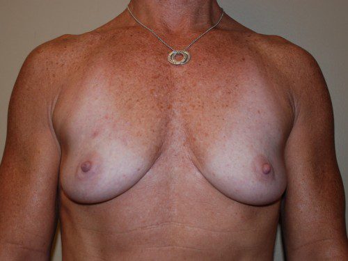 Breast Reconstruction Immediate Implant Before Patient 1