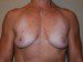 Breast Reconstruction Immediate Implant Before Patient Thumbnail 1