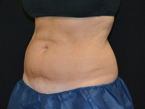 Coolsculpting Before Patient 2